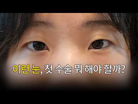 첫 쌍수 전 가장 많이 묻는 4가지 질문|앞트임·눈매교정·쌍꺼풀 라인·뒤밑트임 썸네일 — 마침표TV
